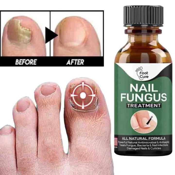 Fast Nail Fungus Treatment Gel – Nail Repair Essence Serum for Healthy, Smooth & Strong Nails