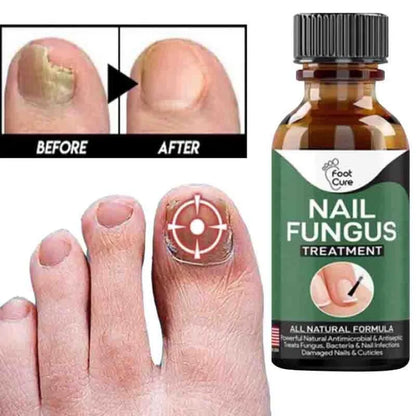 Fast Nail Fungus Treatment Gel – Nail Repair Essence Serum for Healthy, Smooth & Strong Nails
